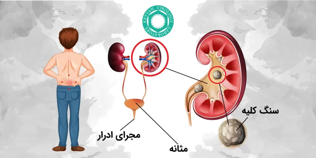 سنگ کلیه