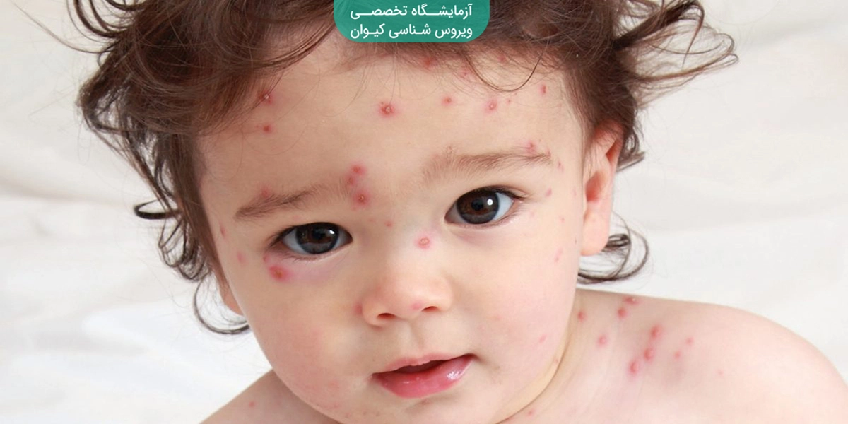 آبله مرغان