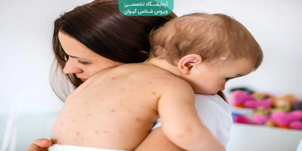 آبله مرغان