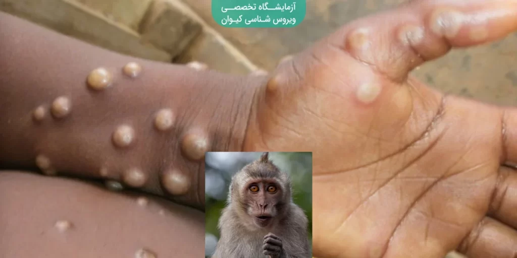 آبله میمون