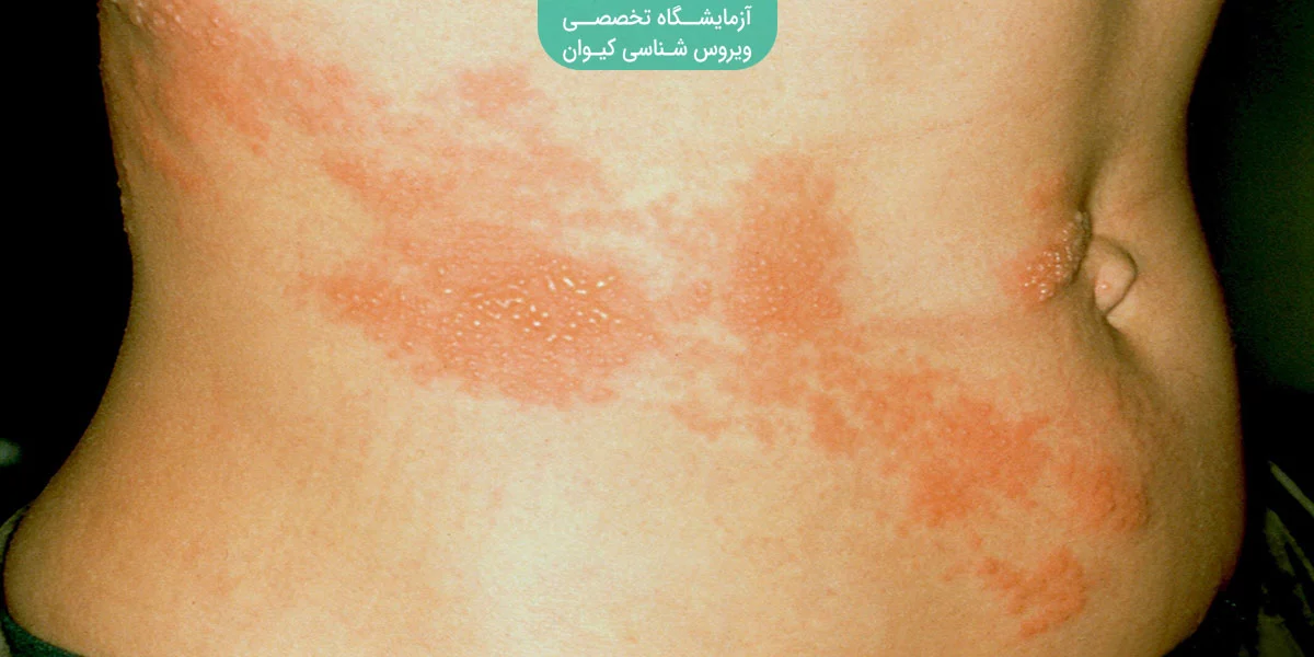 بیماری زونا
