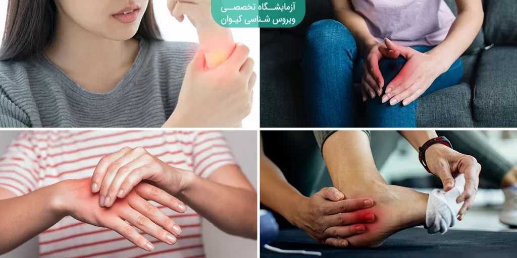 بیماری گیلن باره