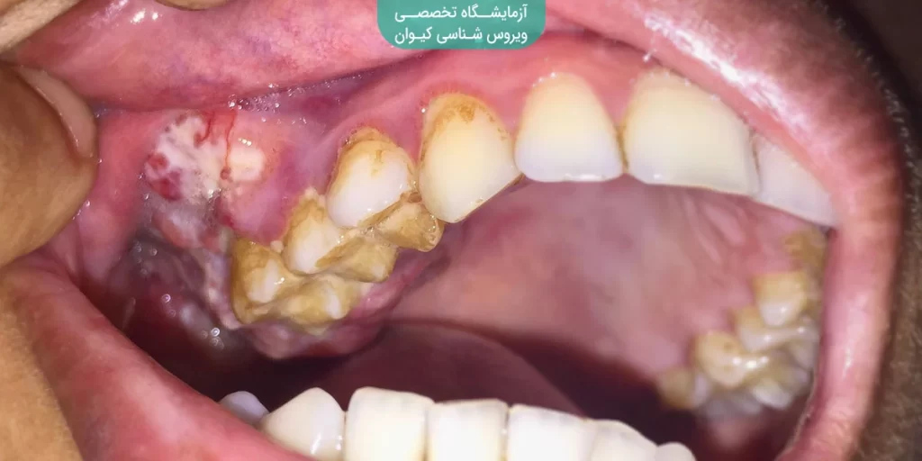 تشخیص سرطان دهان
