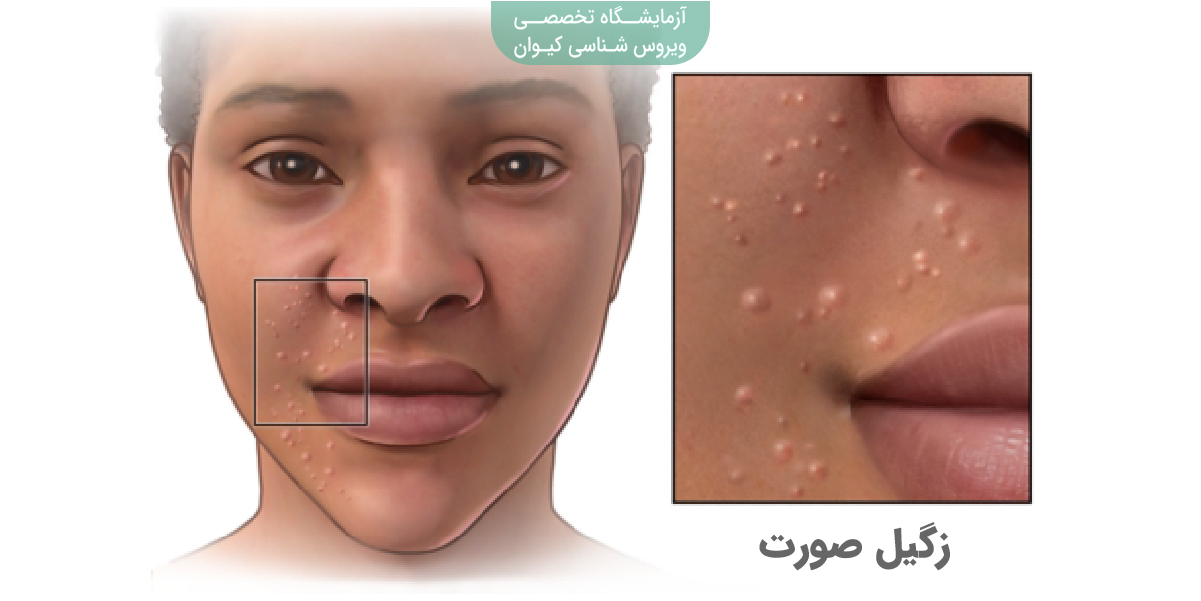 عکس زگیل صورت + انواع زگیل صورت + درمان