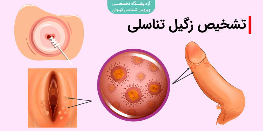 زگیل تناسلی چه شکلیه در زنان؟