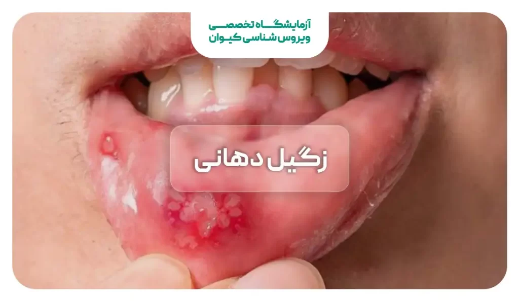 HPV دهانی