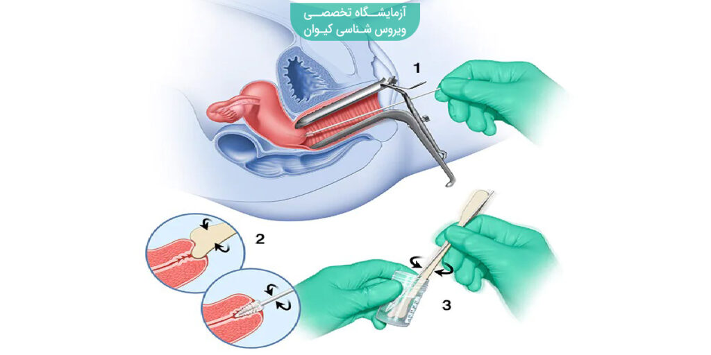 تست پاپ اسمیر چگونه است؟
