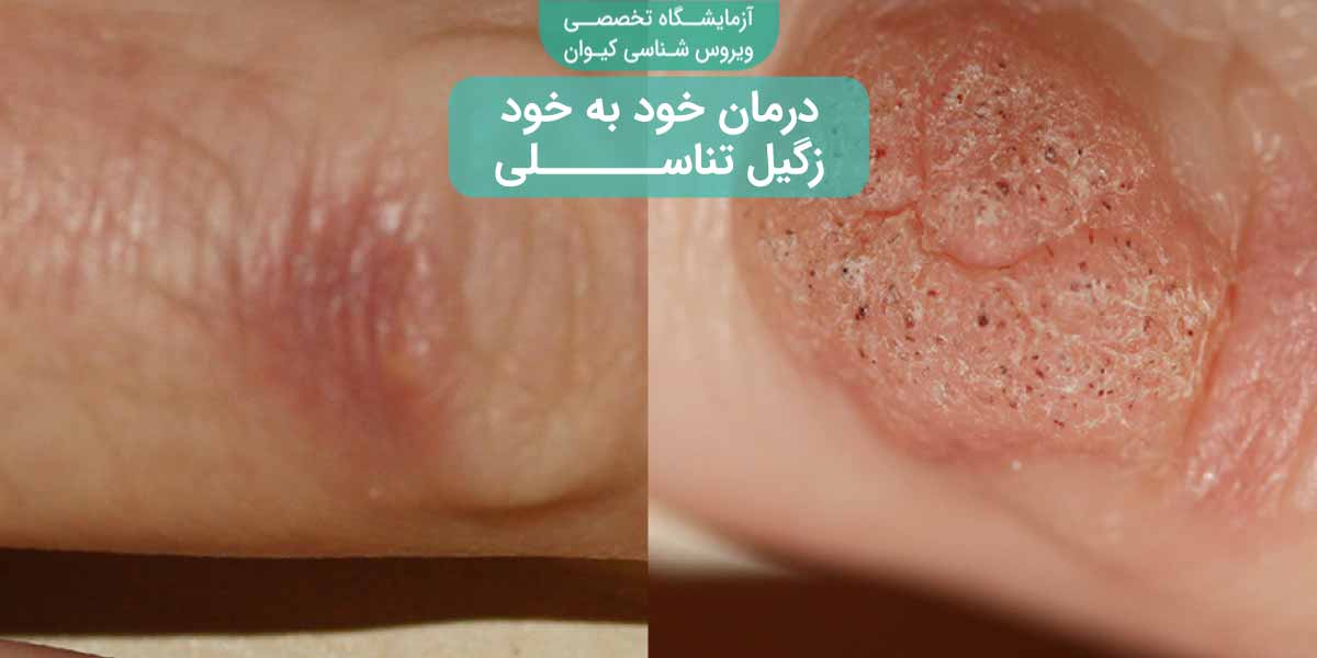 آیا برداشتن زگیل تناسلی درد دارد؟