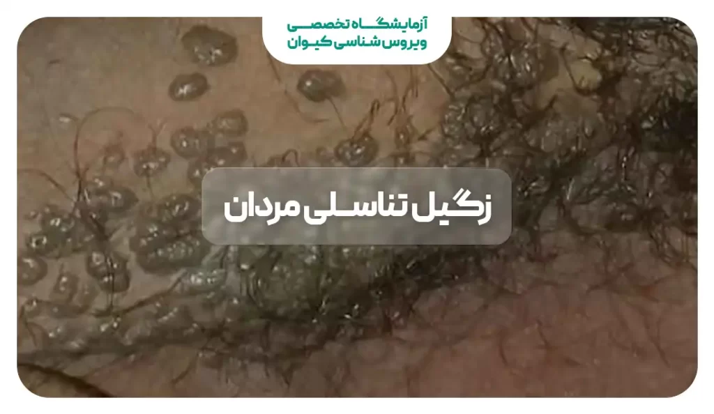 زگیل تناسلی مردان