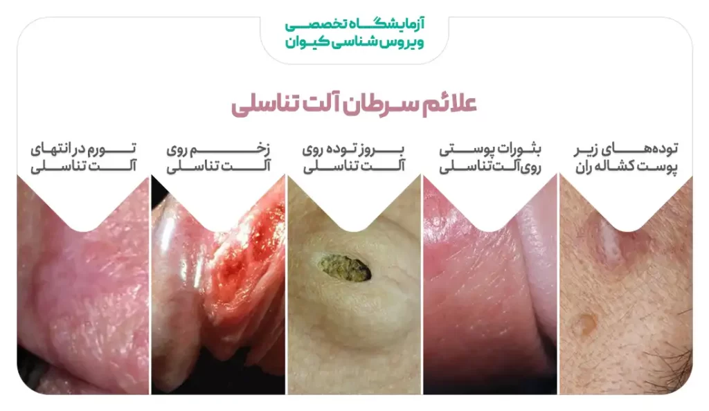 علائم سرطان آلت تناسلی
