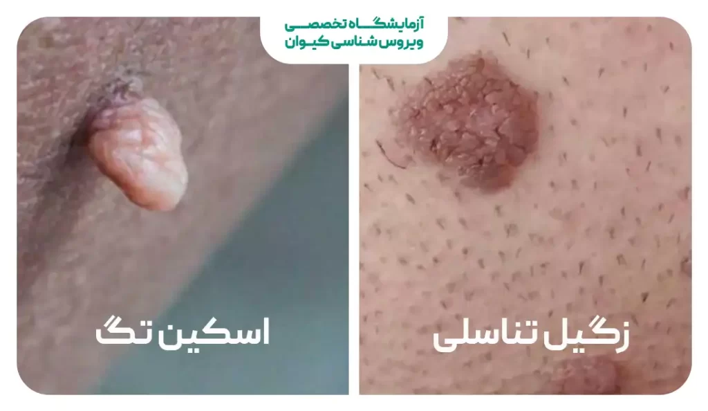 تفاوت زگیل تناسلی و اسکین تگ