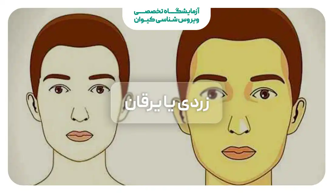زردی یا یرقان چیست؟