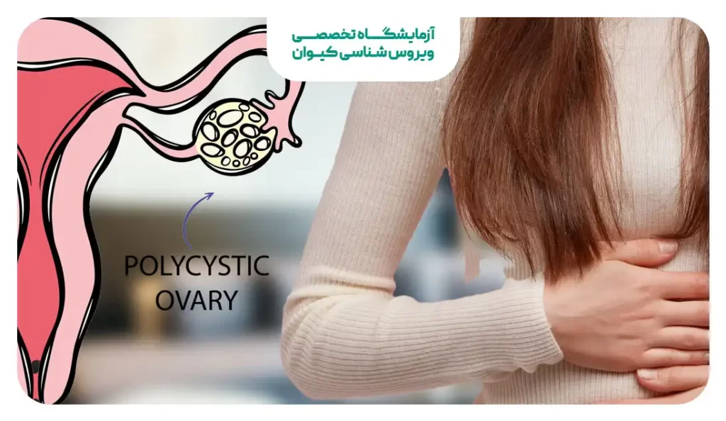 سندرم تخمدان پلی کیستیک و تاخیر پریودی
