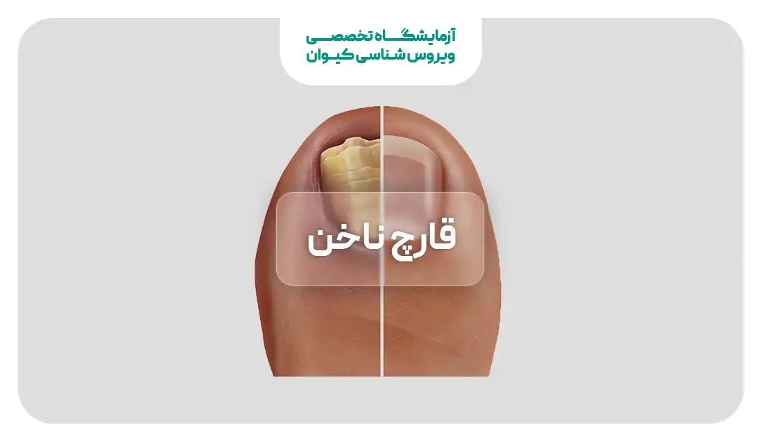 قارچ ناخن