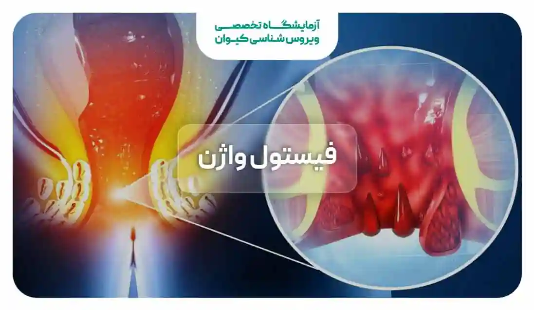 فیستول واژن