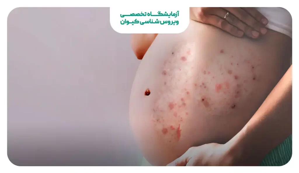 آبله مرغان در بارداری