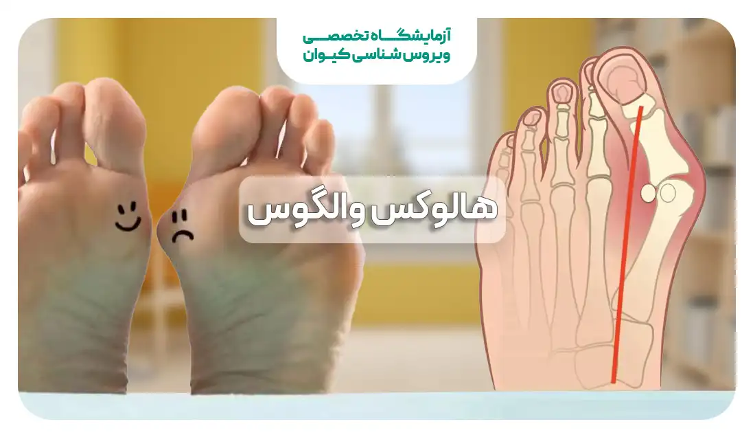 هالوکس والگوس
