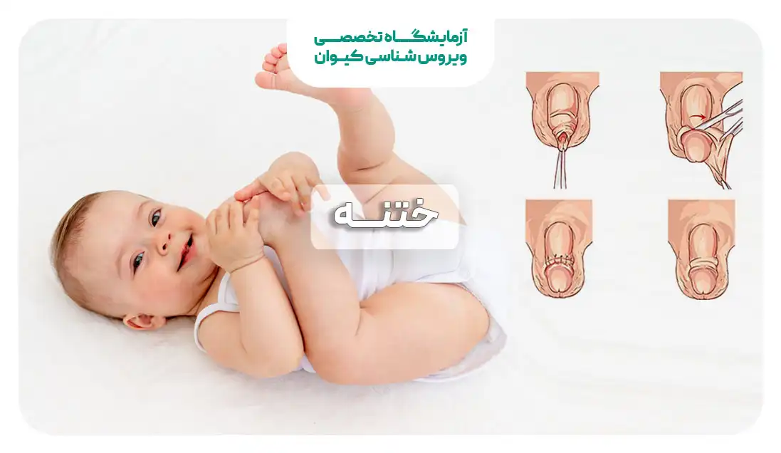 ختنه