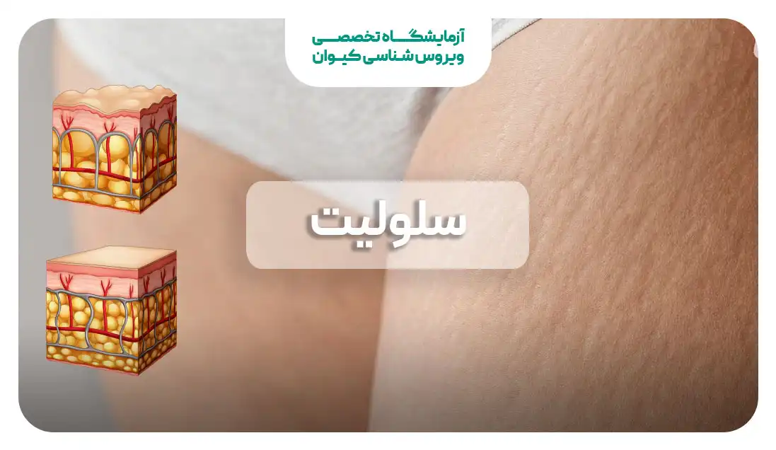سلولیت و لیپادم چیست؟