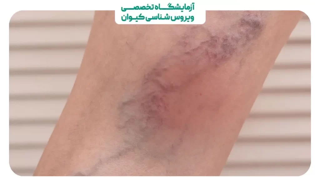عوارض گرفتن رگ سیاتیک