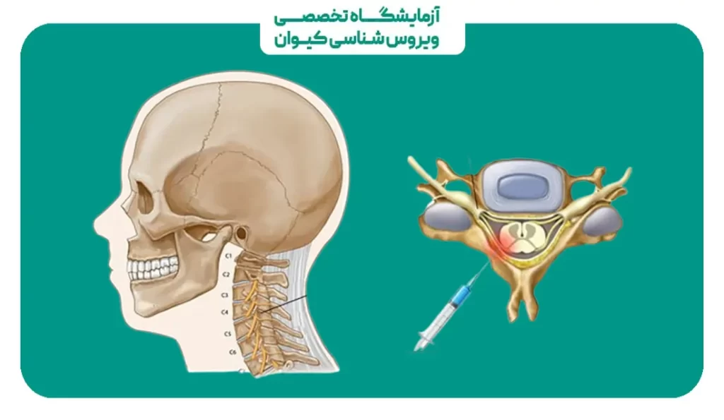 تزریق اپیدورال برای گردن