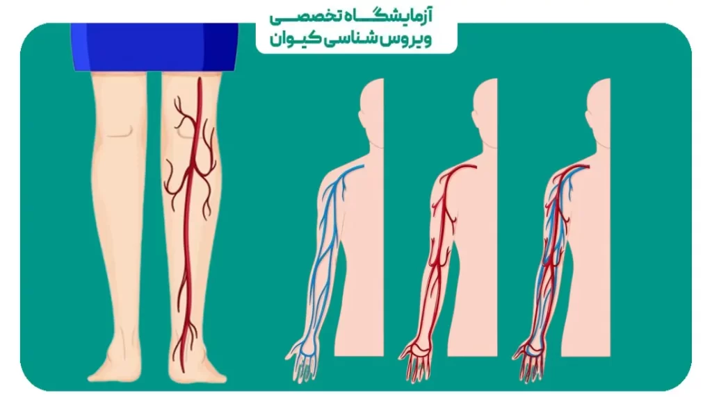 گرفتگی رگ سیاتیک