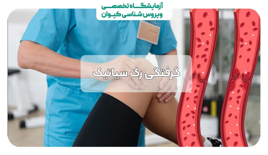 گرفتگی رگ سیاتیک