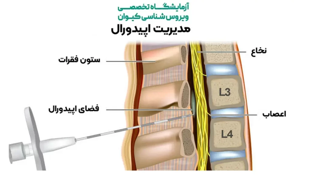 فضای تزریق اپیدورال