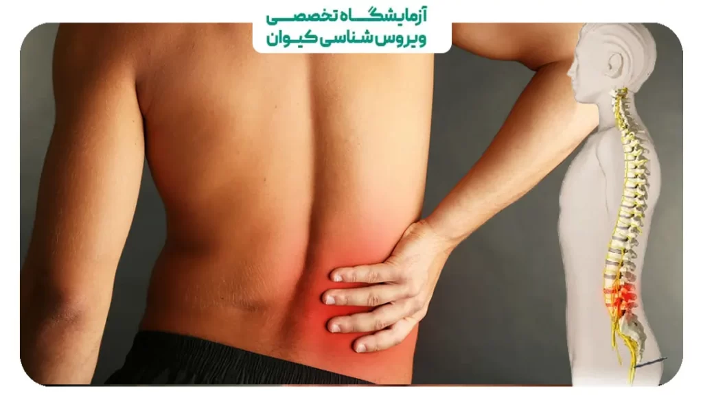 گرفتگی رگ سیاتیک کمر 