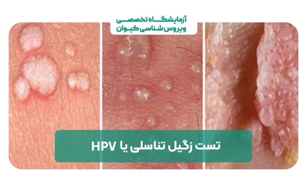 آزمایش و تست زگیل تناسلی یا hpv در منزل توسط آزمایشگاه کیوان