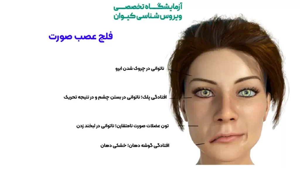 نشانه ها و علائم فلج بلز